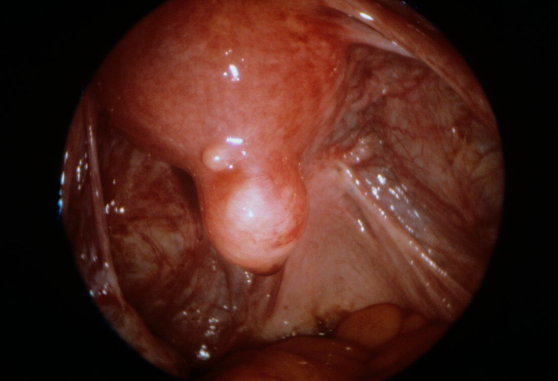 Uterine fibroid,endoscope view
