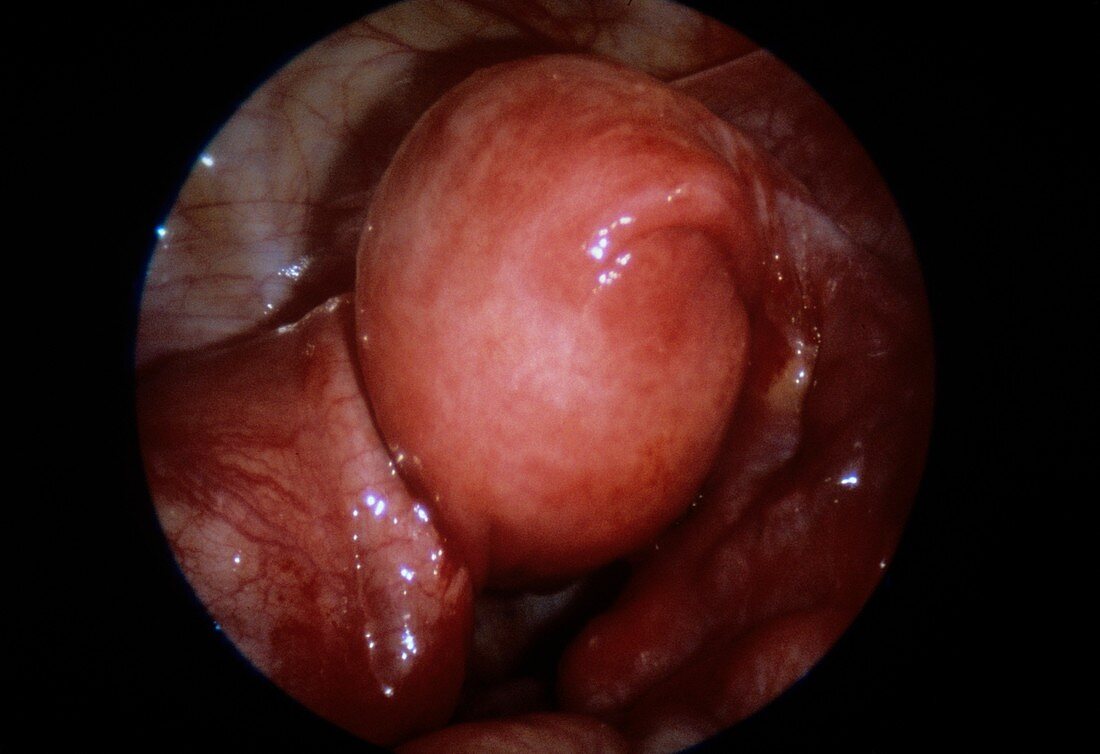 Pyosalpinx of fallopian tube