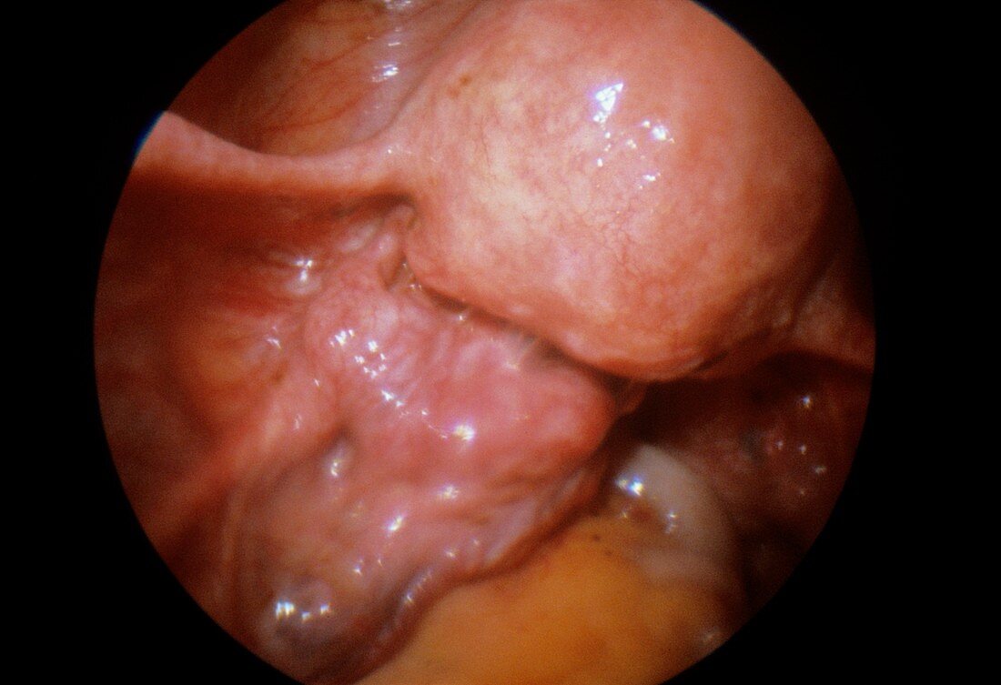 Womb varicocele,endoscope view