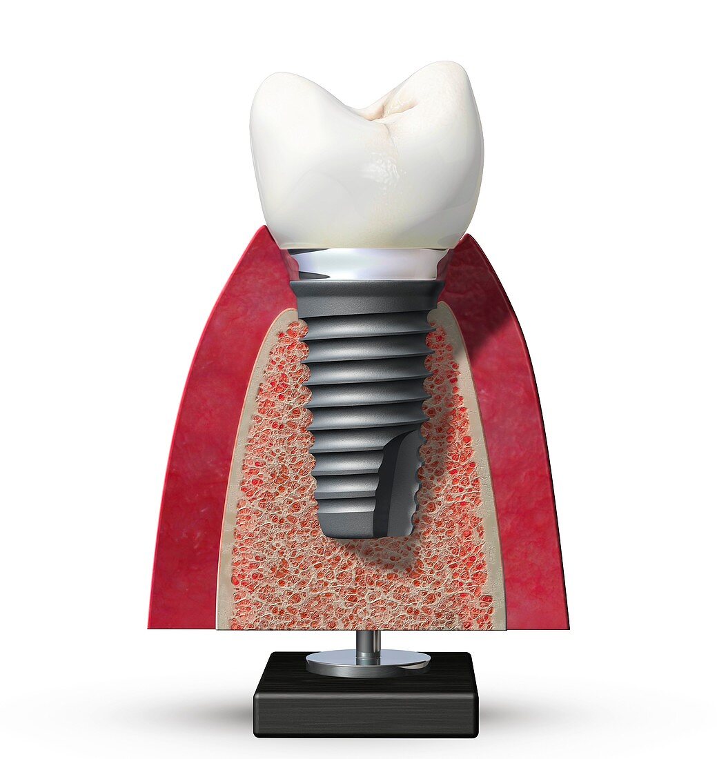 Dental implant,artwork