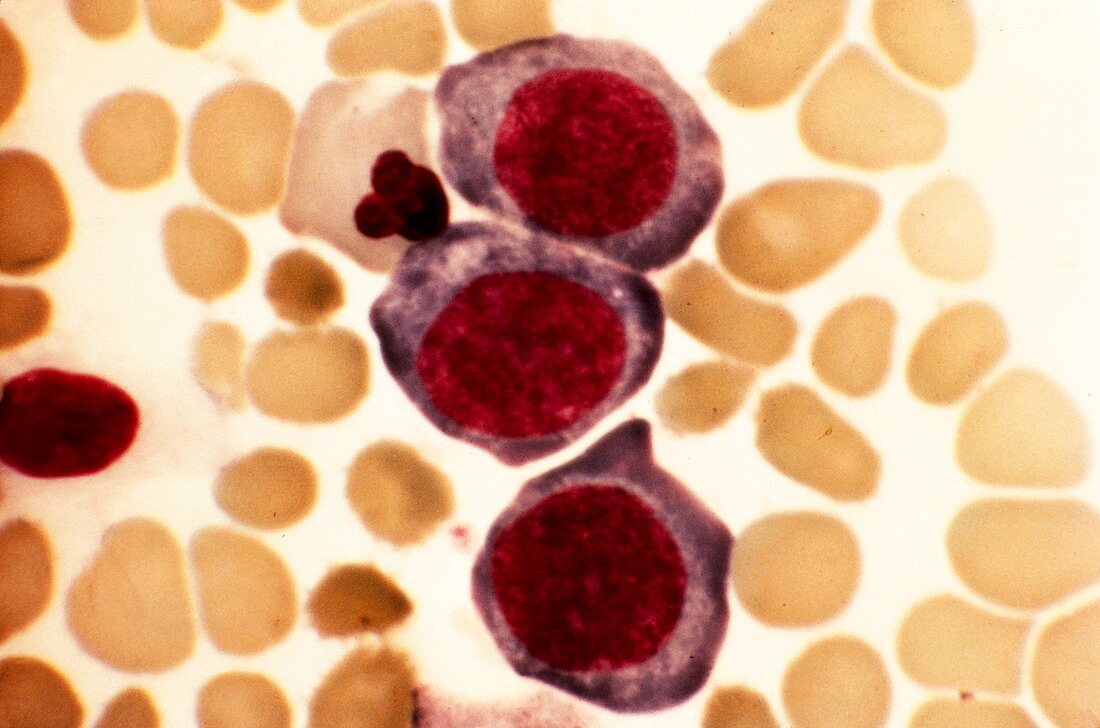 Pernicious anaemia,light micrograph