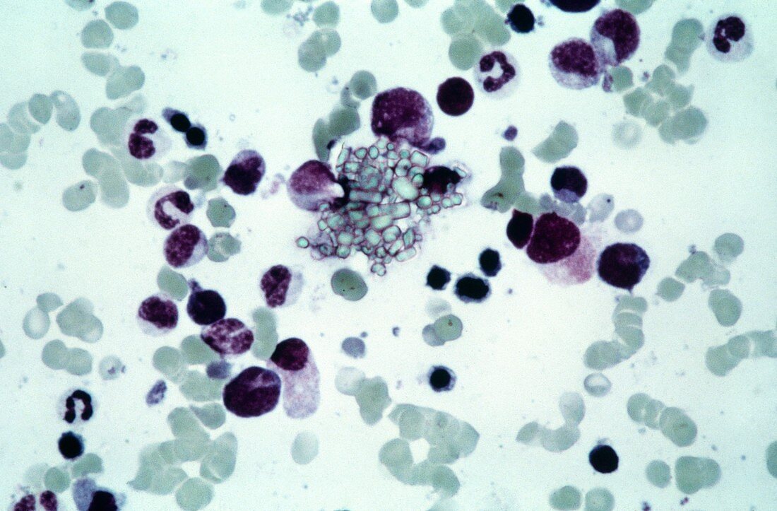 Cystine in bone marrow,light micrograph