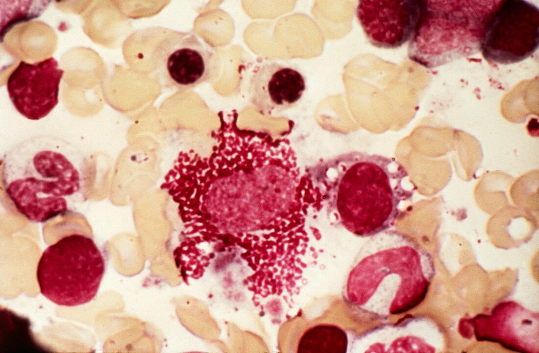 Langerhans cell histiocytosis,micrograph