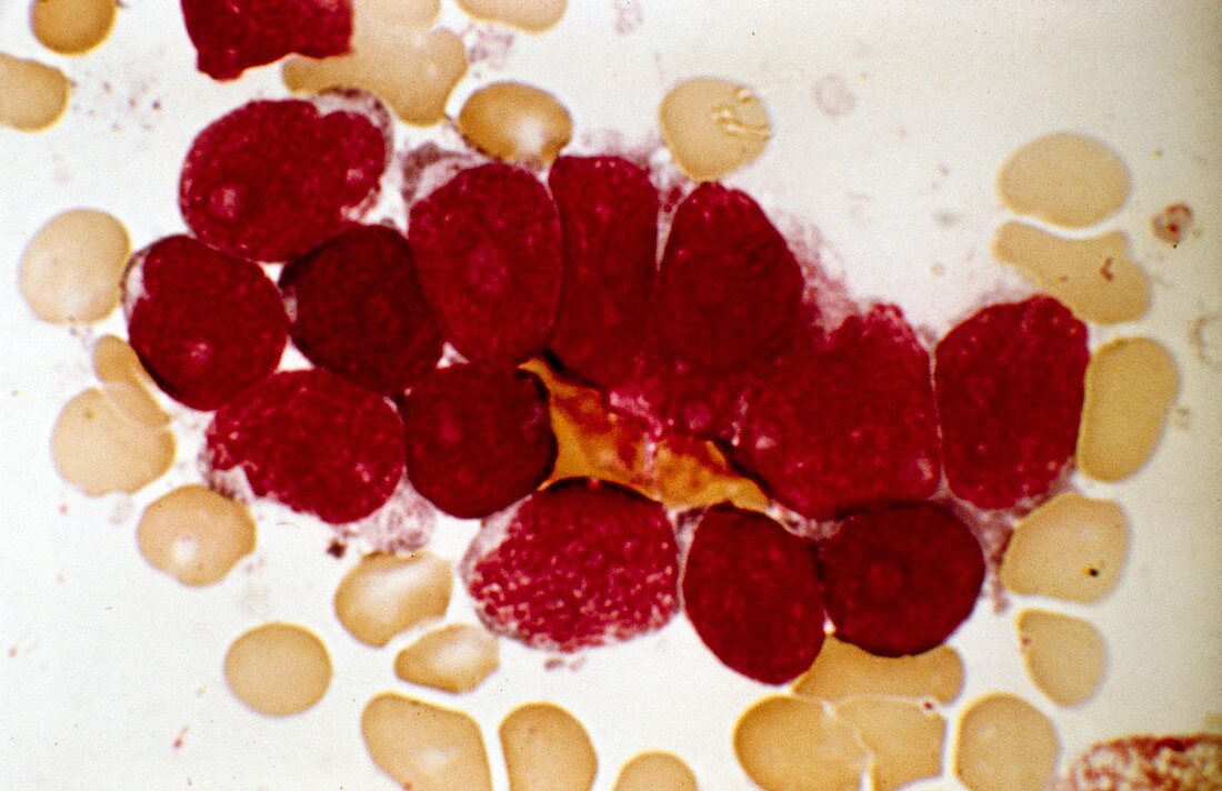 Acute lymphoblastic leukaemia,micrograph
