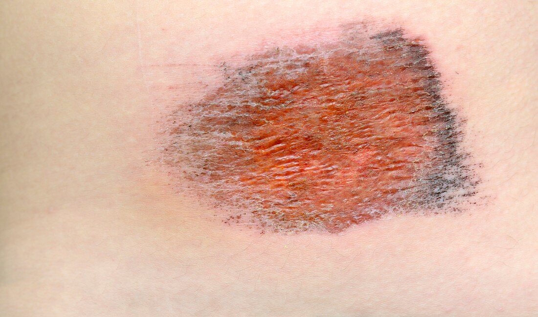 Abrasion of the skin