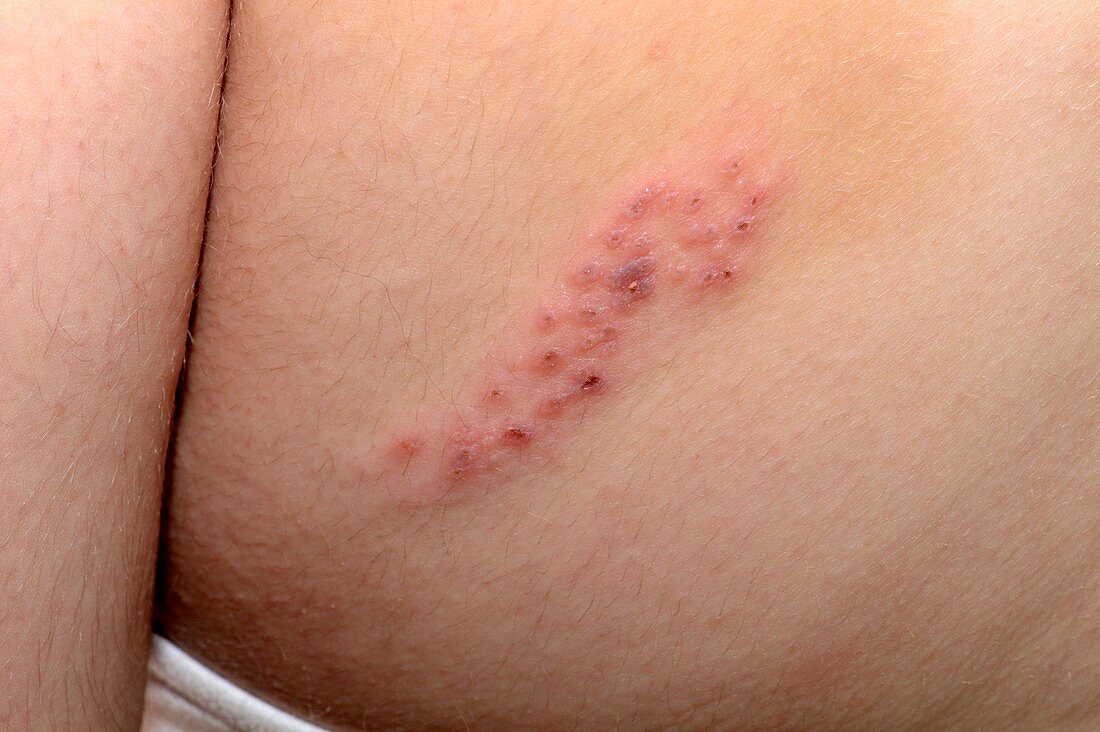 Shingles rash