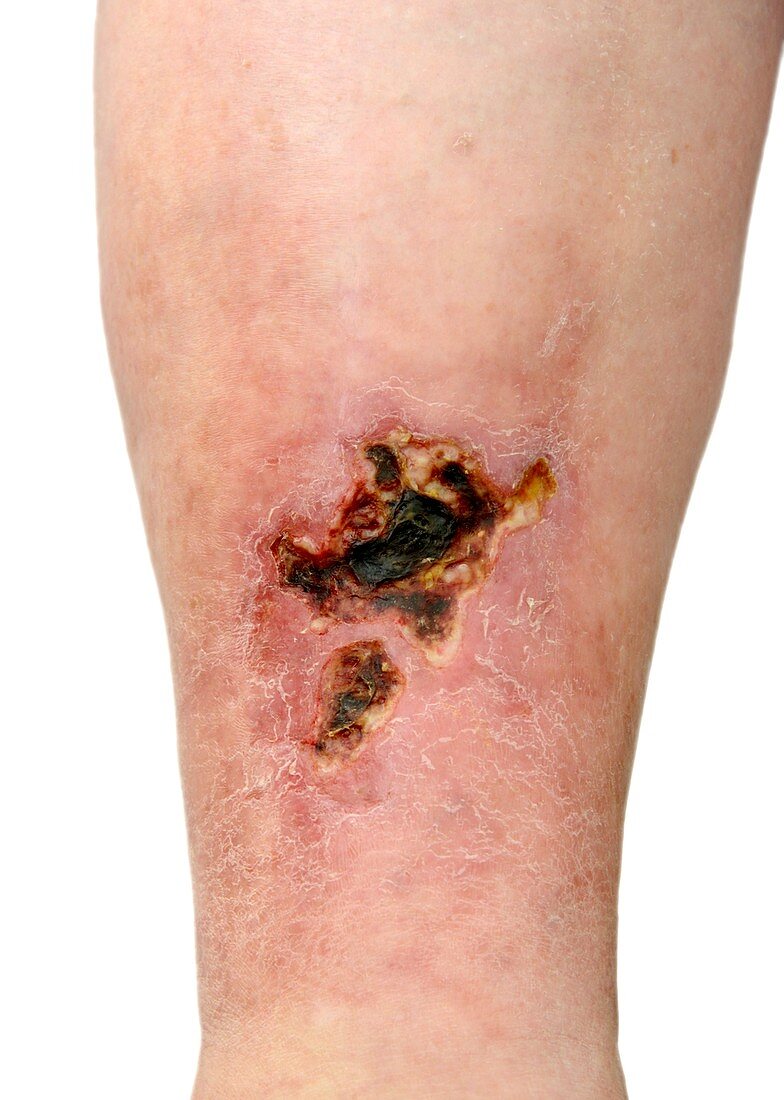 Leg ulcer with scabbing