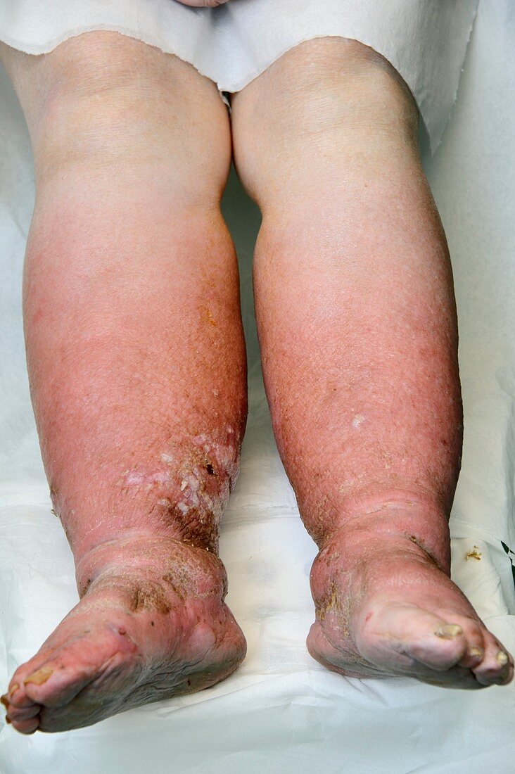 Chronic oedema of the legs