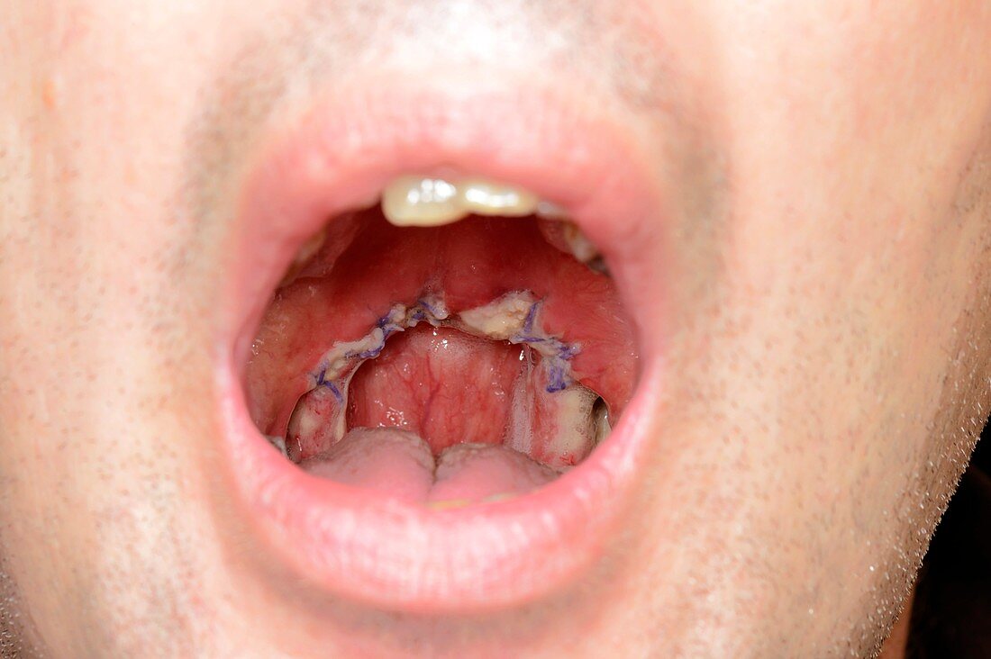 Surgical removal of tonsils