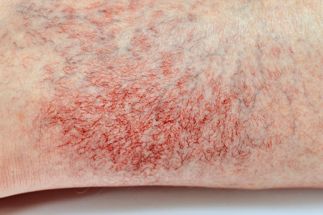 Enlarged blood vessels on the skin
