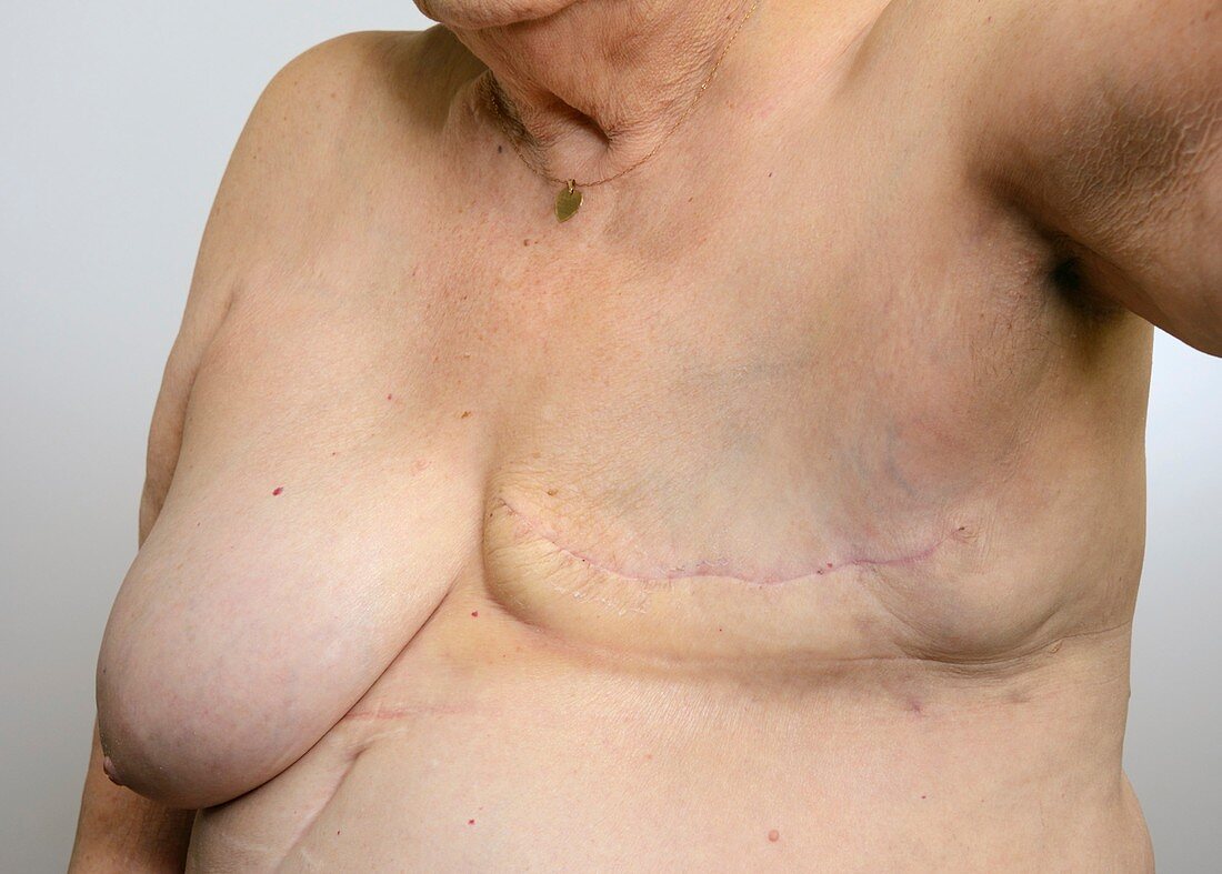 Mastectomy scar