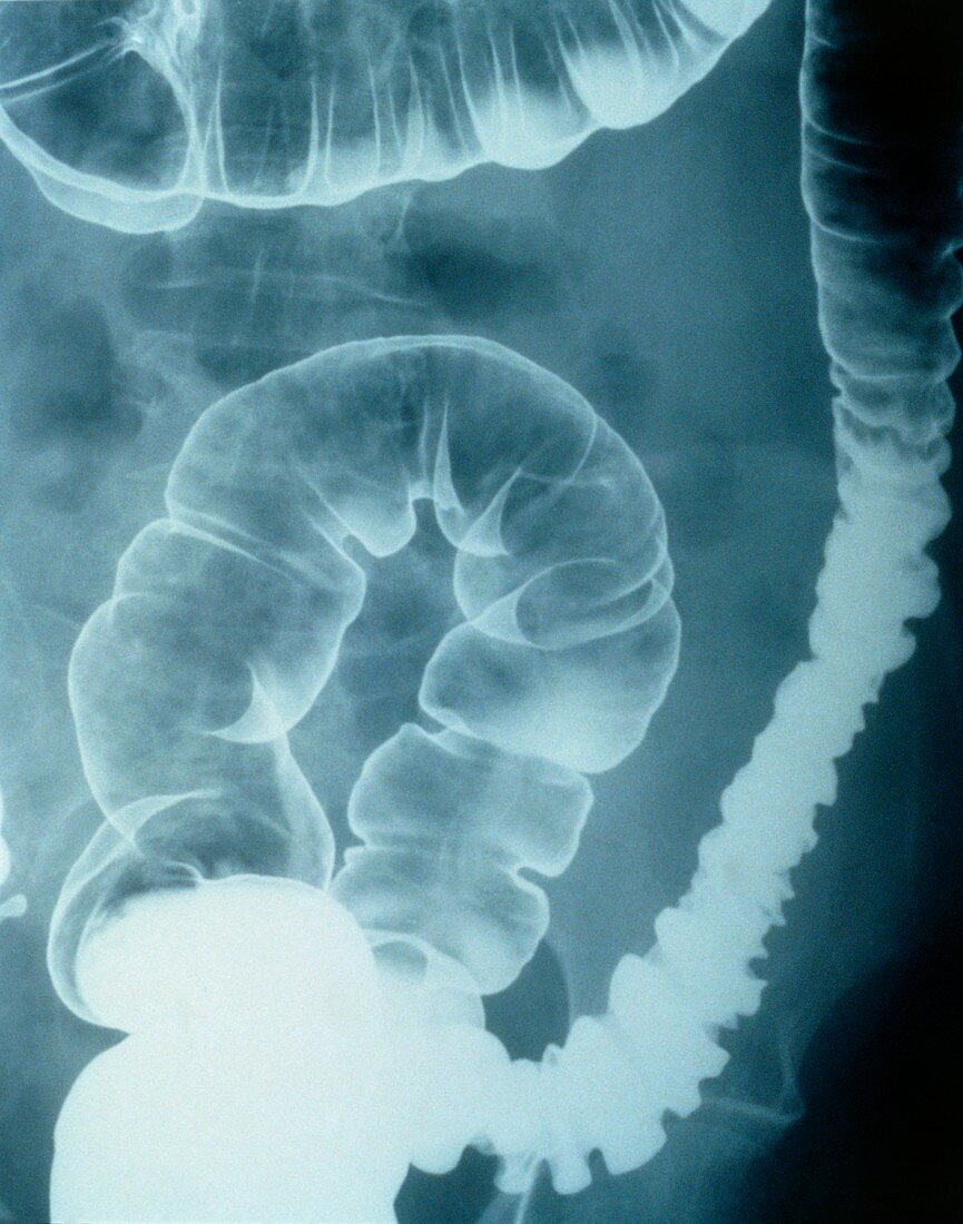 Colonic spasm,X-ray
