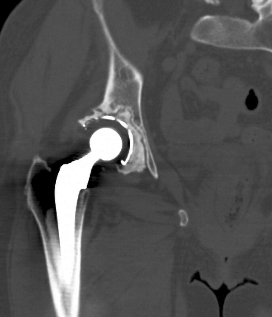 Failed hip replacement,CT scan