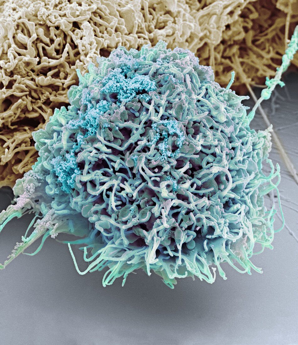 Vaginal cancer cell,SEM