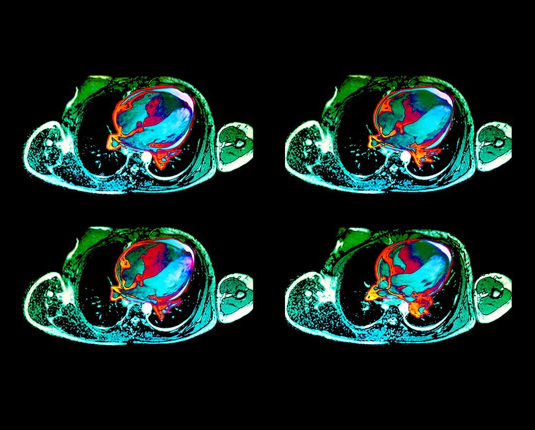 Cardiac lymphoma,MRI scans