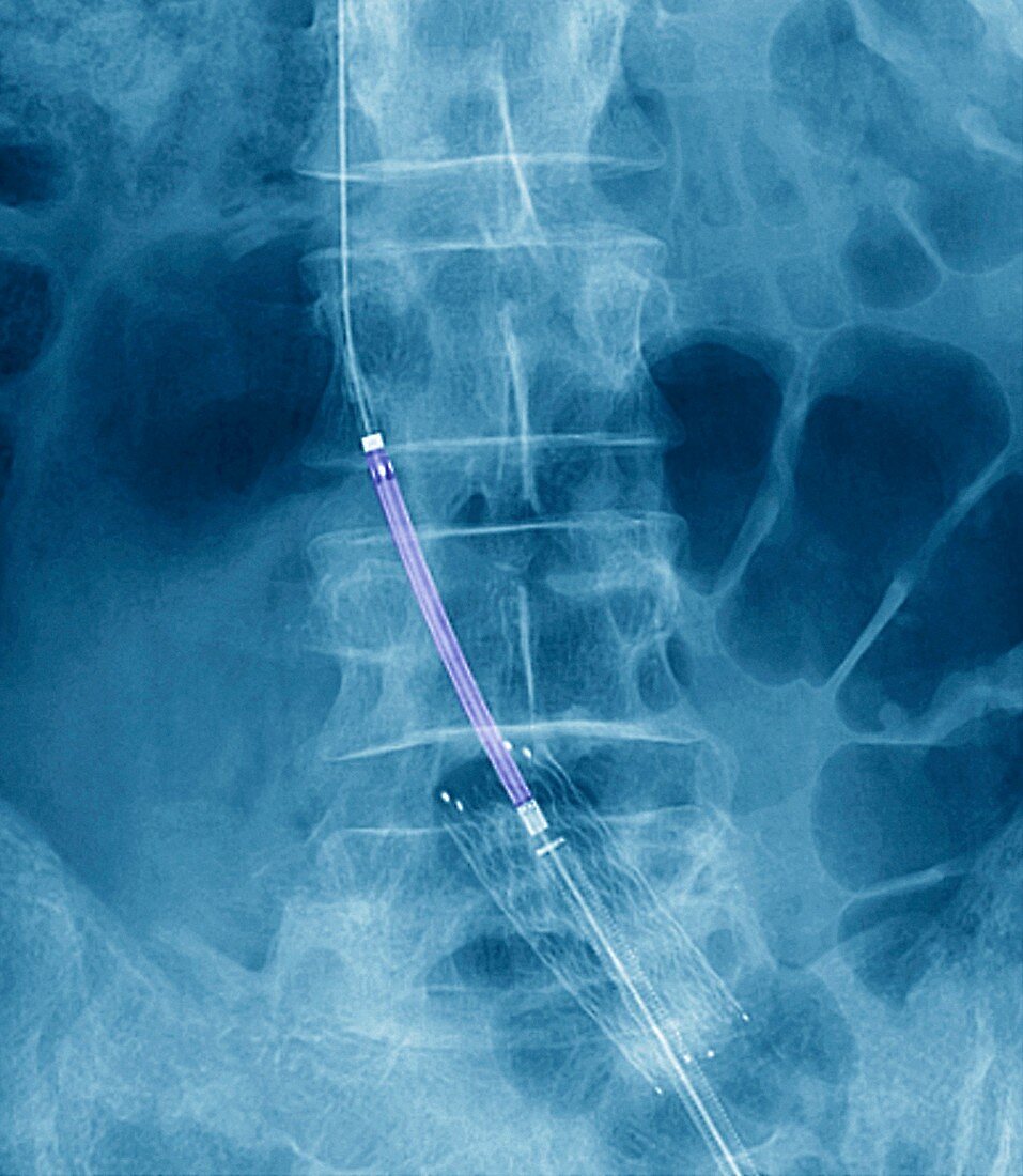 Balloon angioplasty,X-ray