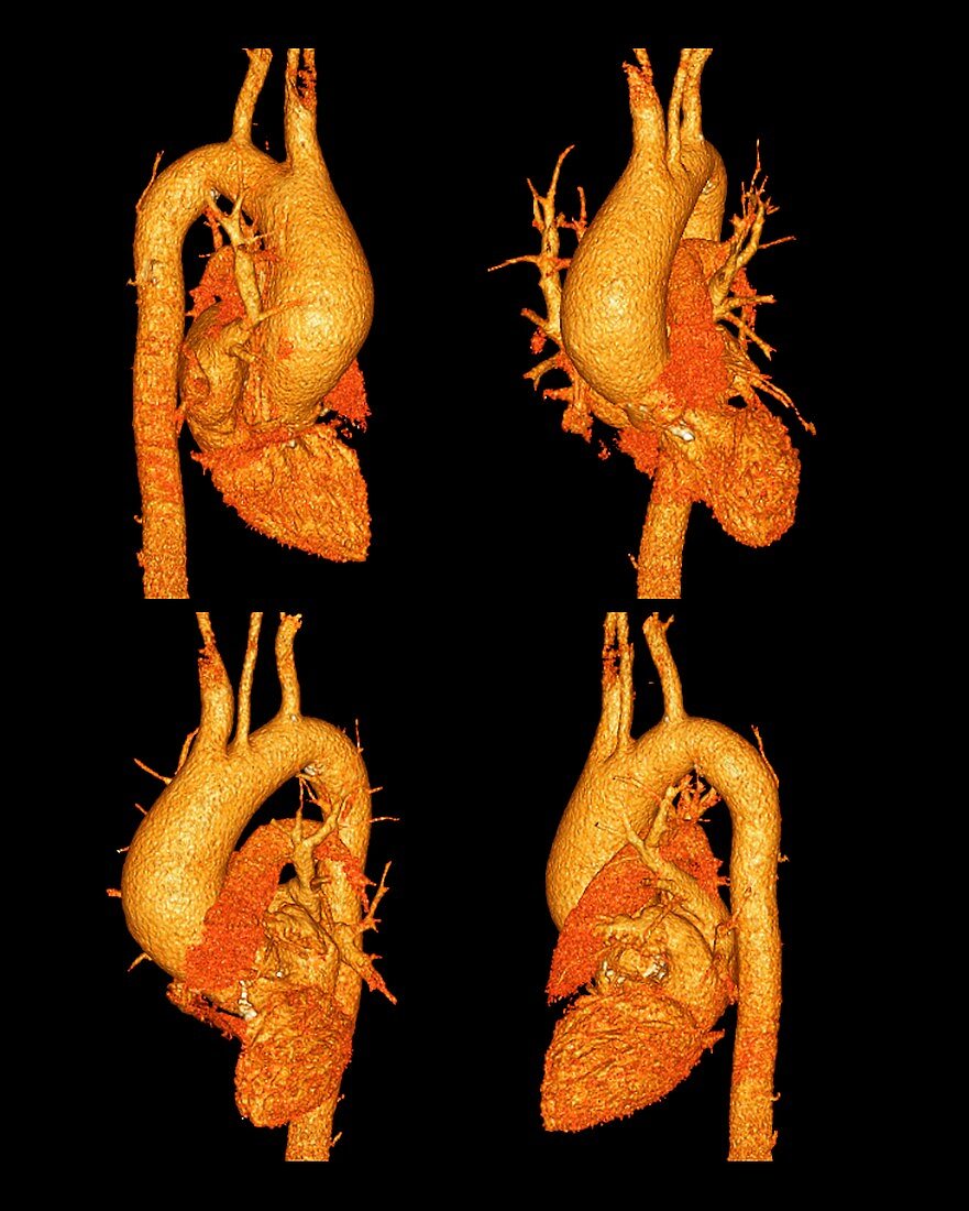 Narrowed aorta,3D CT scans