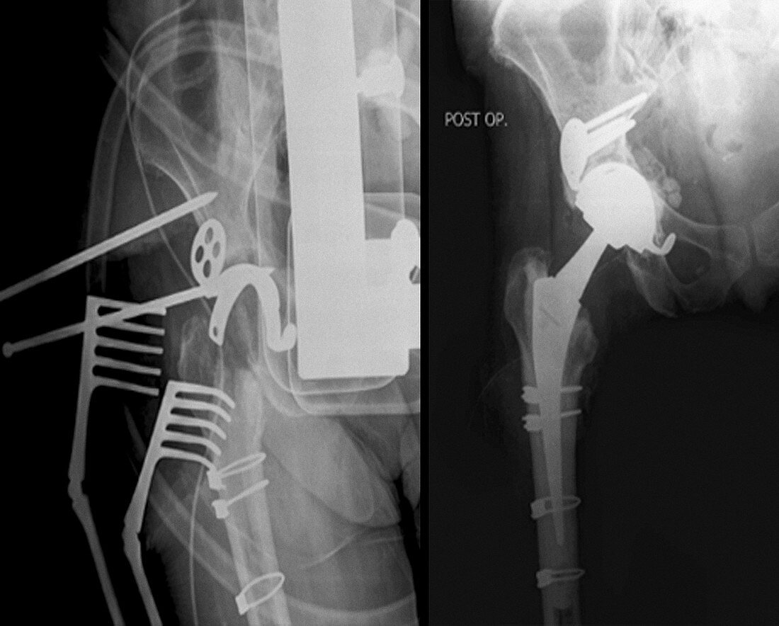 Total hip replacement,X-rays