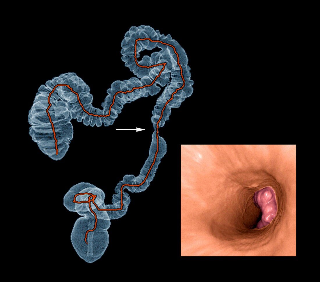 Colon cancer,CT scans