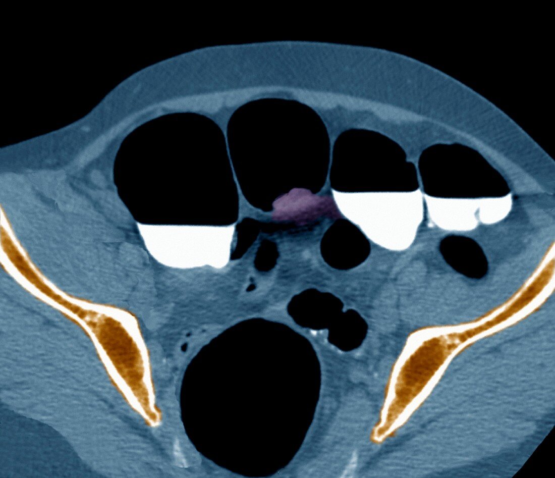 Colon cancer,barium contrast CT scan