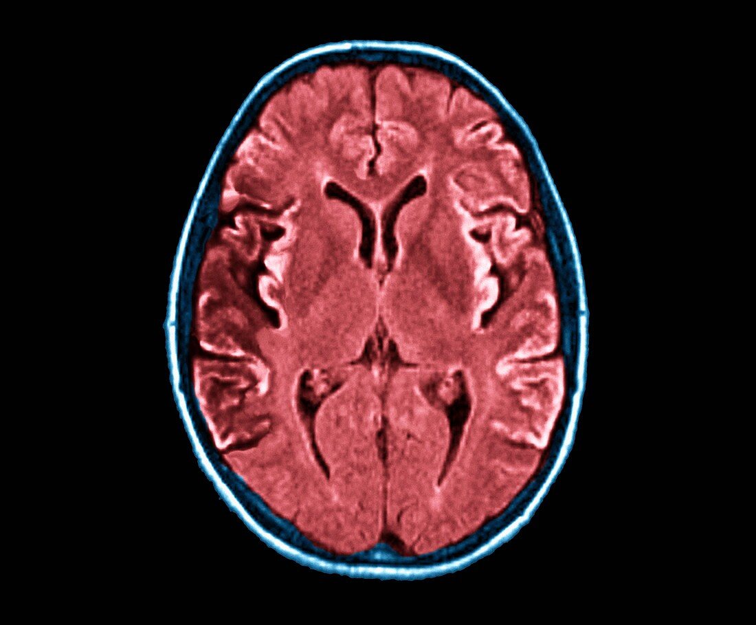 Creutzfeldt-Jakob disease,MRI scan