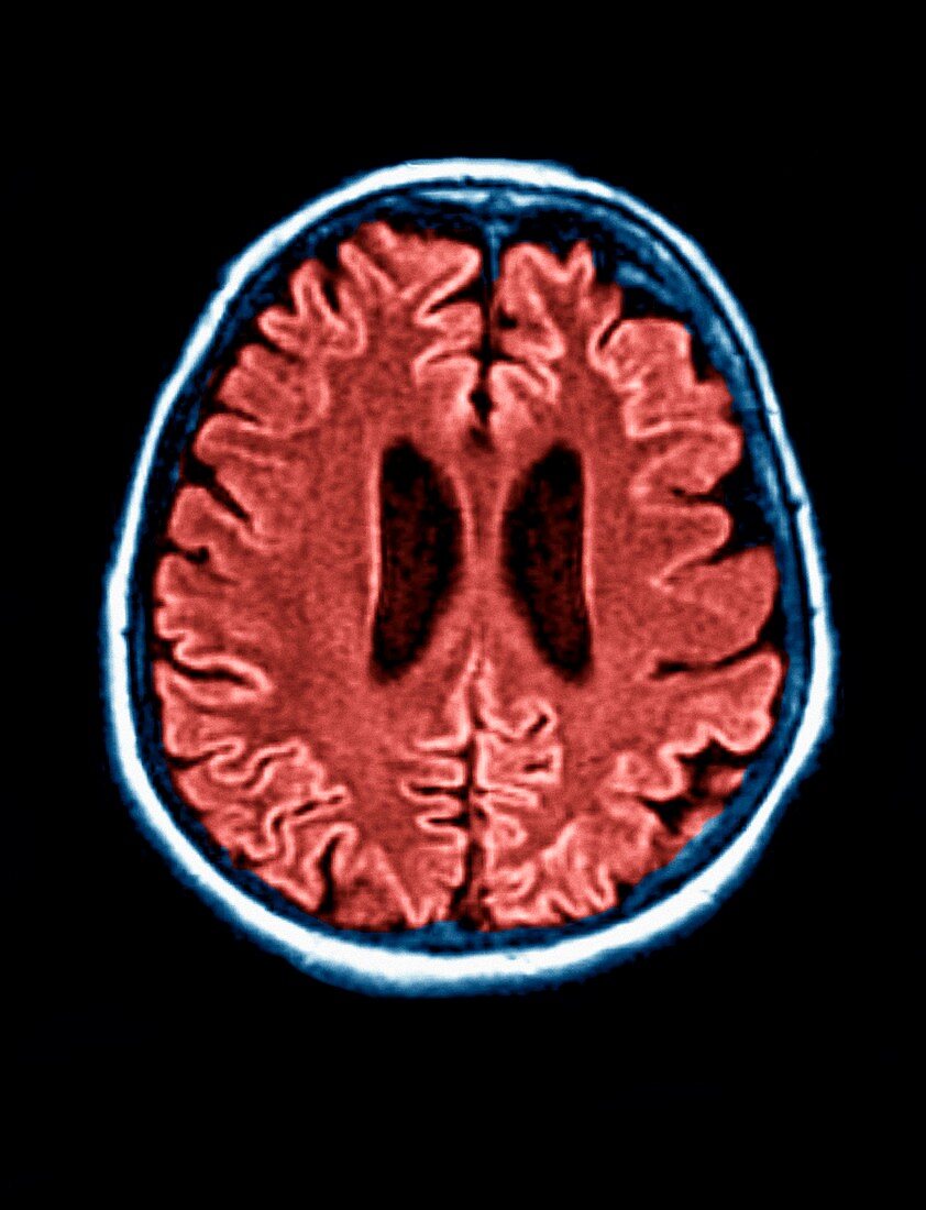 Creutzfeldt-Jakob disease,MRI scan