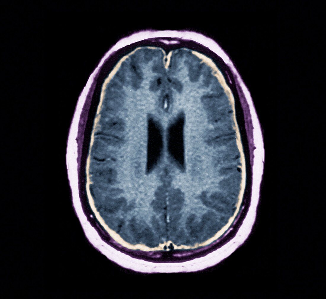 Bacterial meningitis,MRI scan