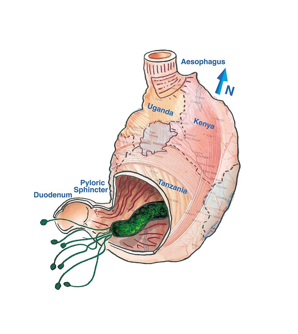 Stomach ulcer bacteria origins,artwork