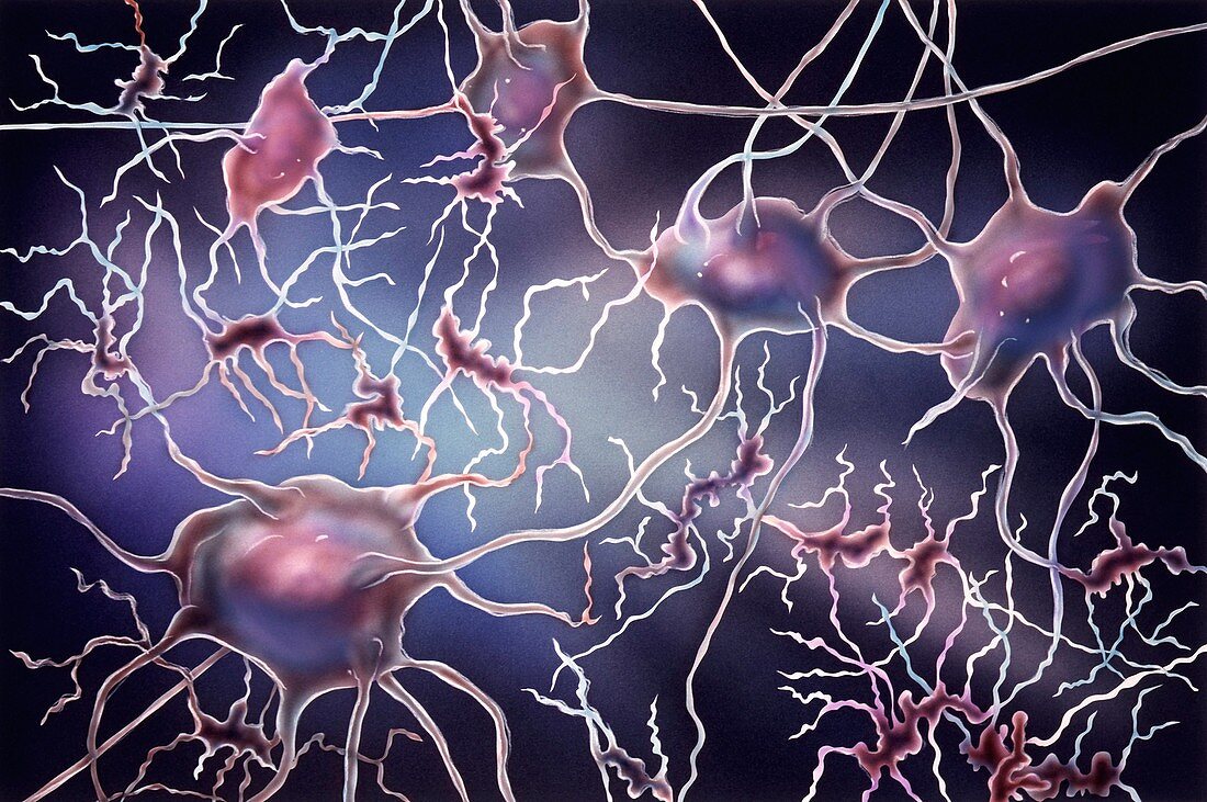 Nerve cell degeneration,artwork