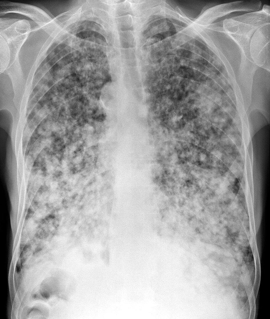 Secondary lung cancers,X-ray