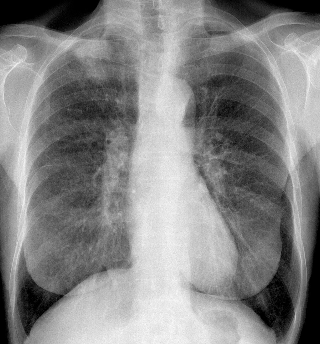 Lung cancer,X-ray