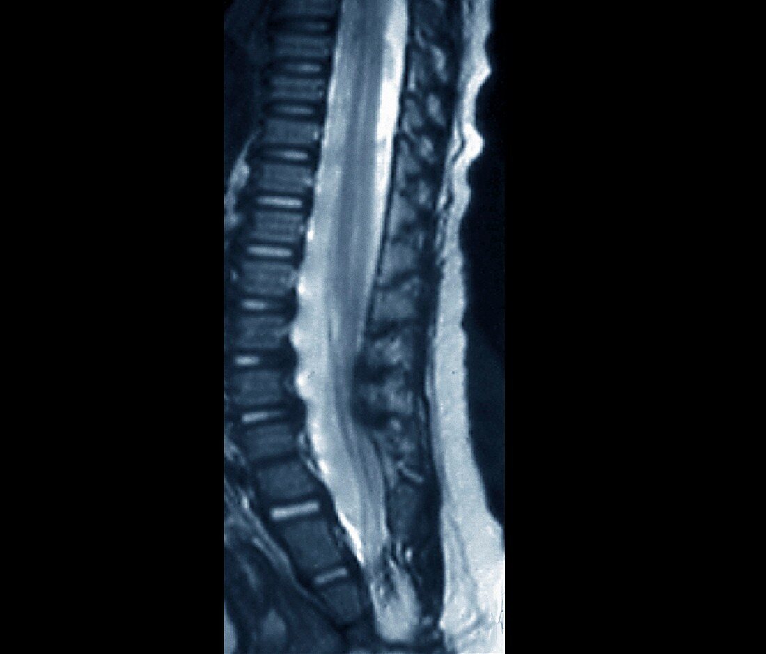 Fibrolipoma of the spine,MRI scan