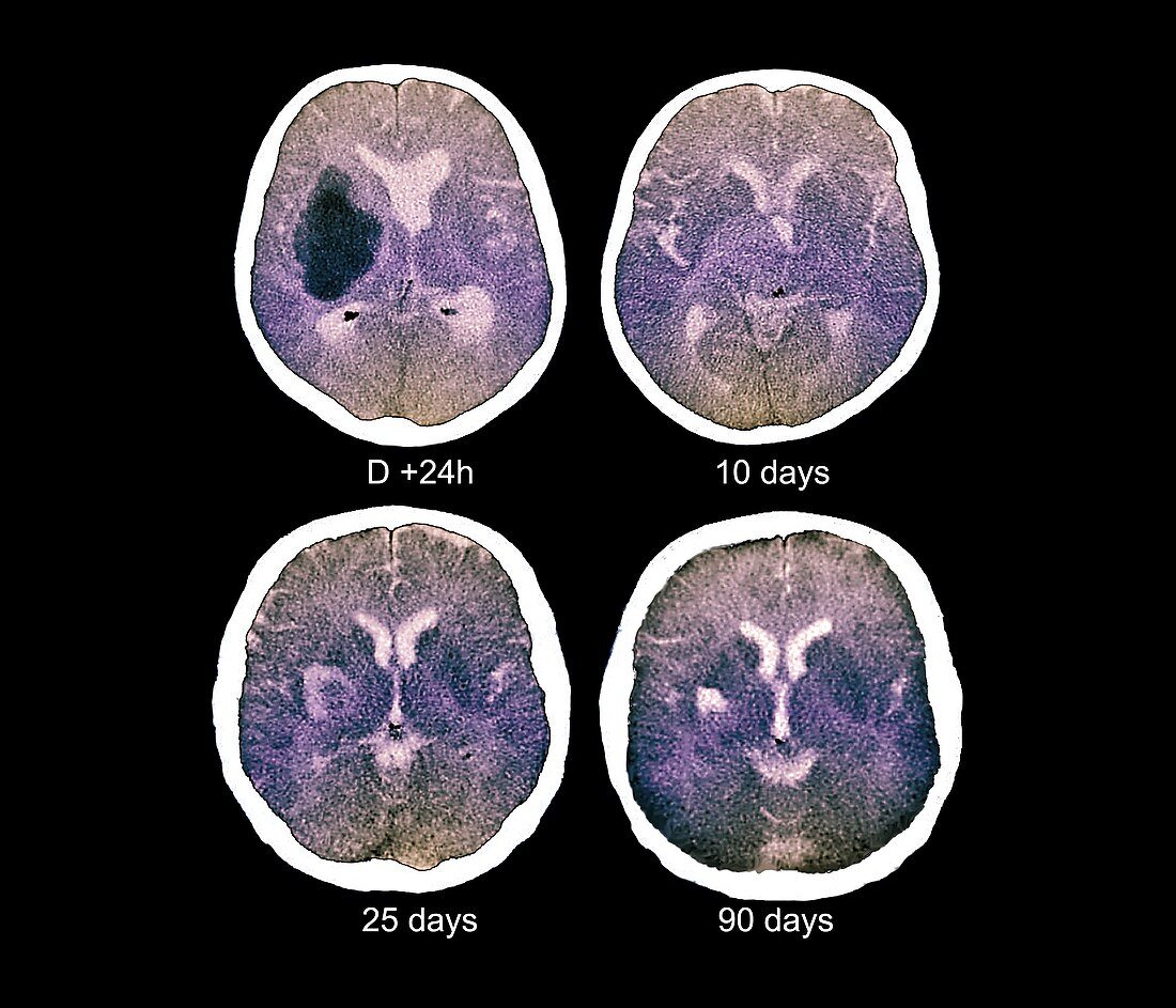 Stroke,CT scans