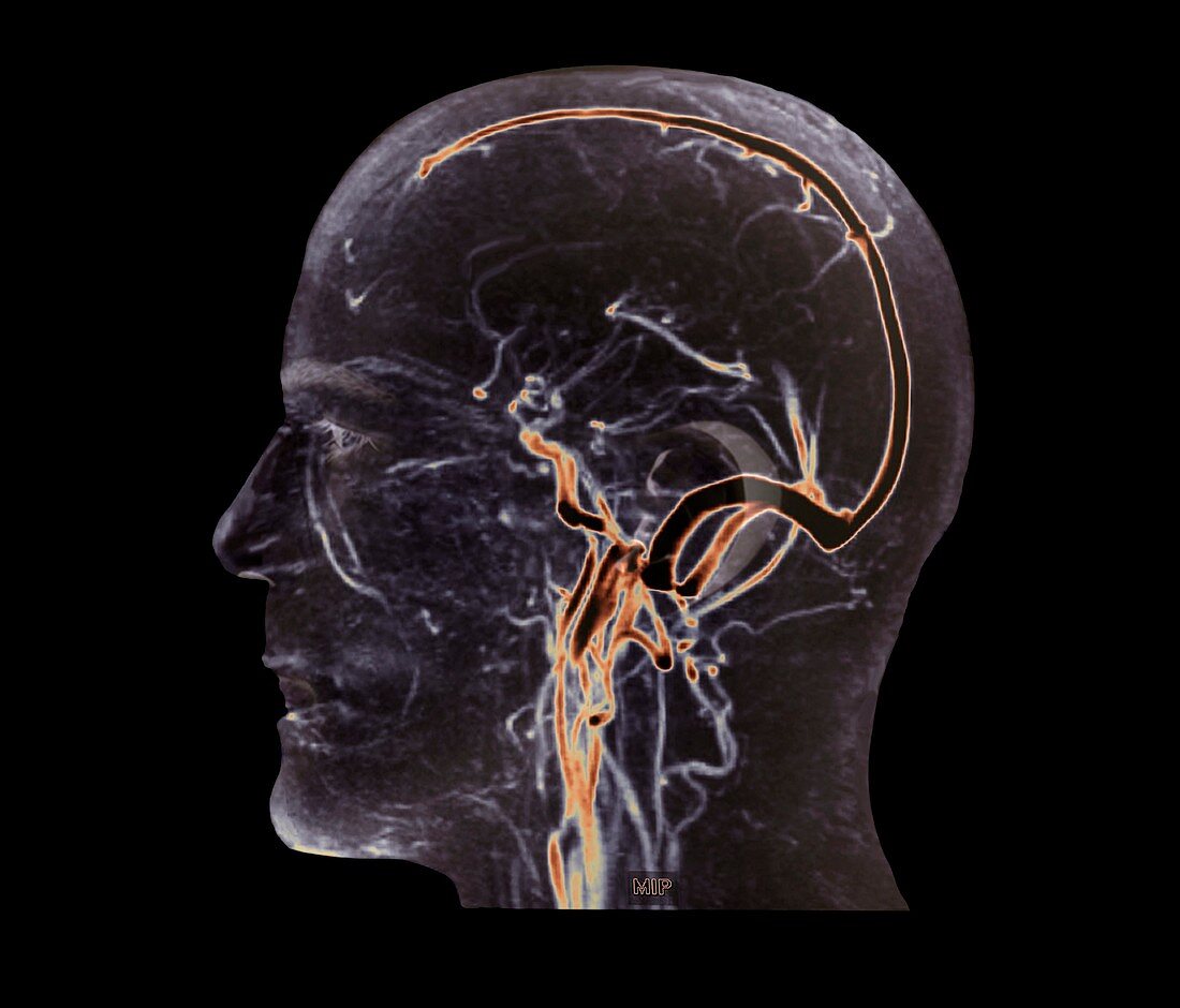 Vascular system of the head,MRI scan