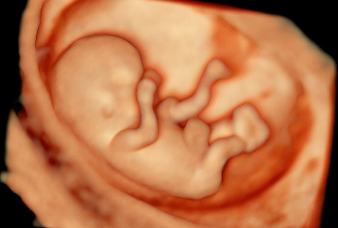 11 week foetus,3-D ultrasound scan