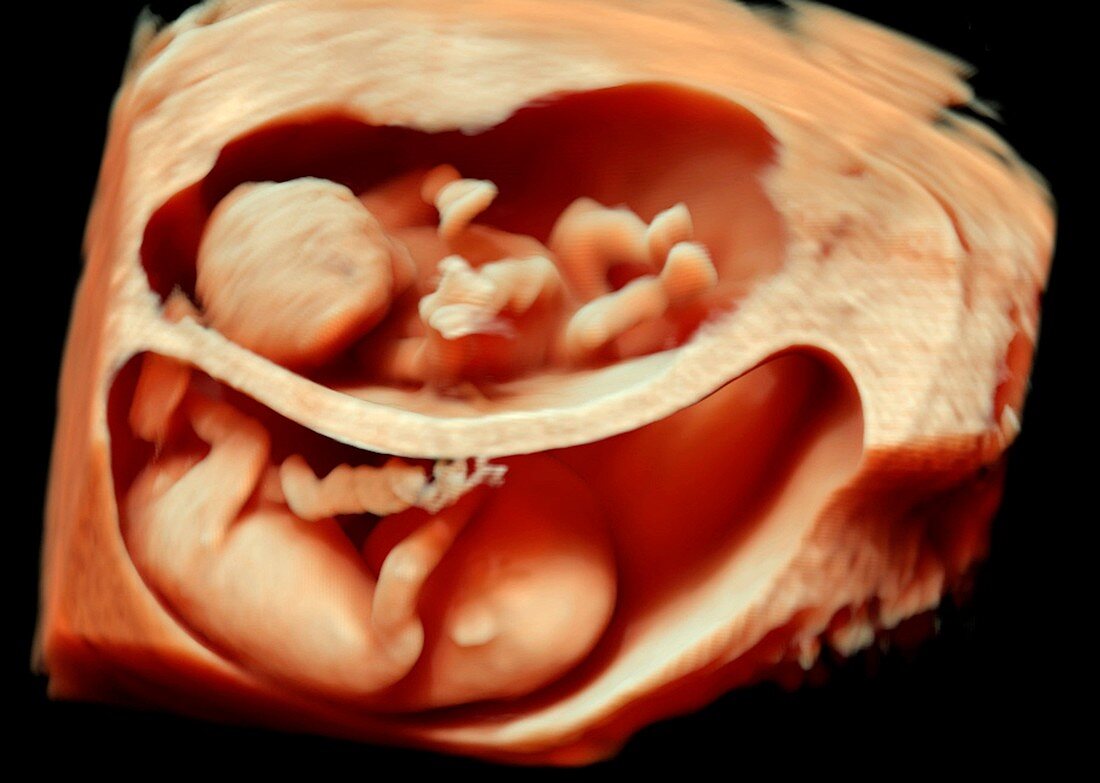 11 week foetus twins,3-D ultrasound scan