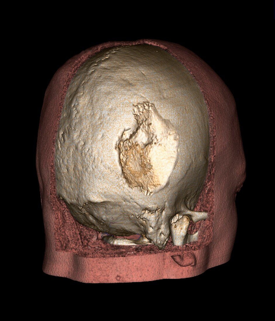 Gorham's disease,3D CT scan
