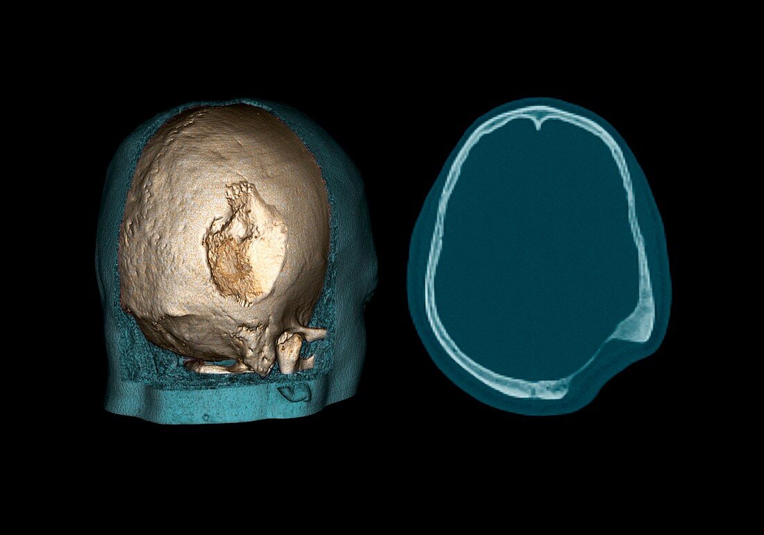 Gorham's disease,CT scans