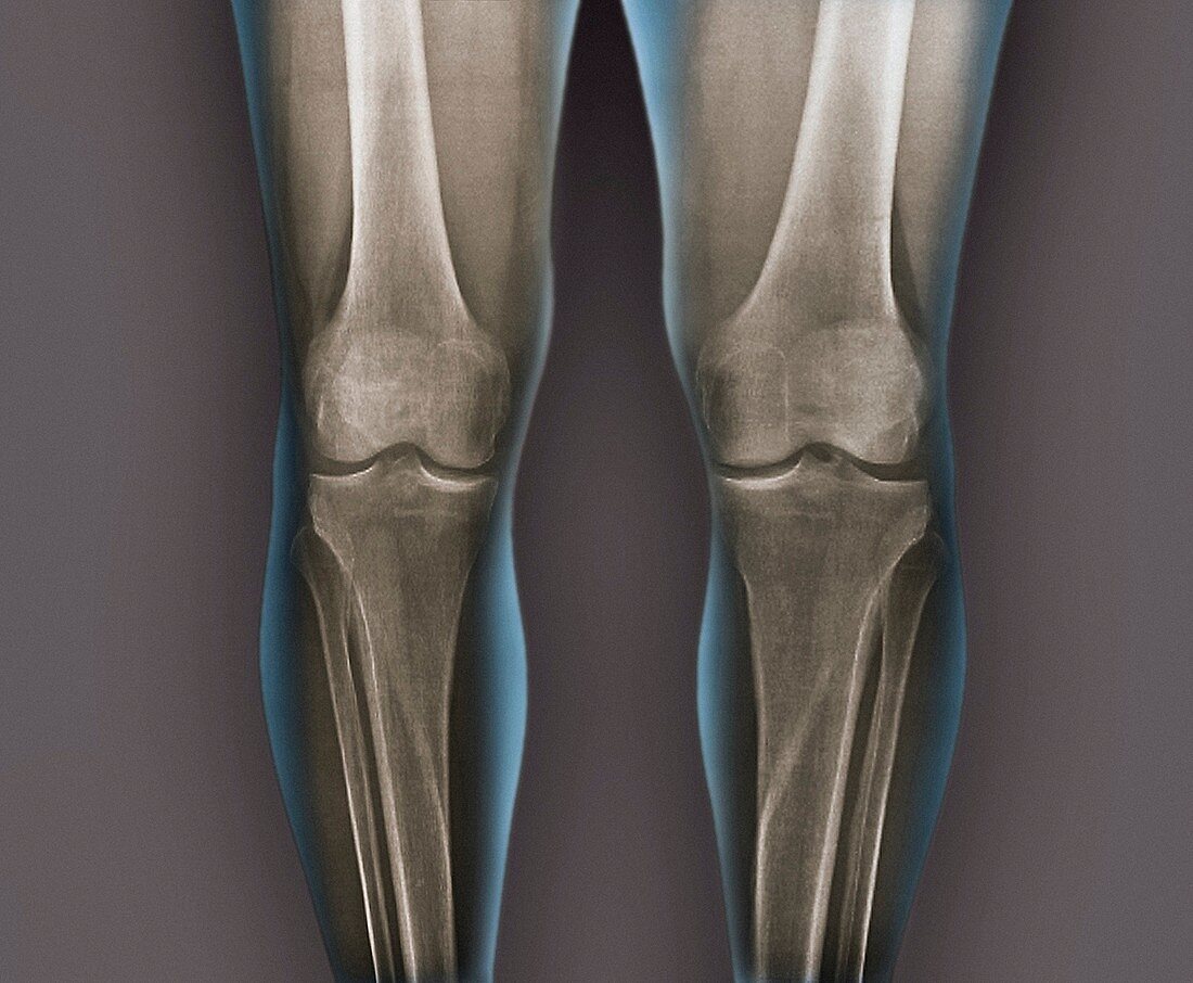 Normal knees,X-rays