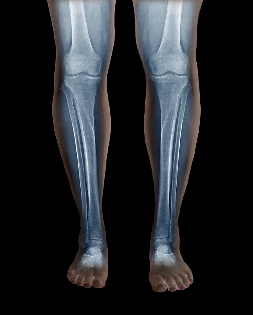 Normal legs,X-rays
