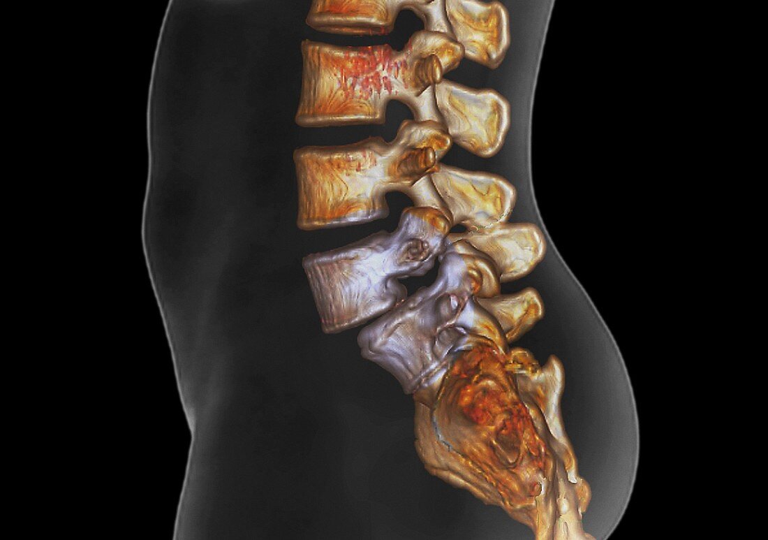 Spondylolisthesis,CT scan