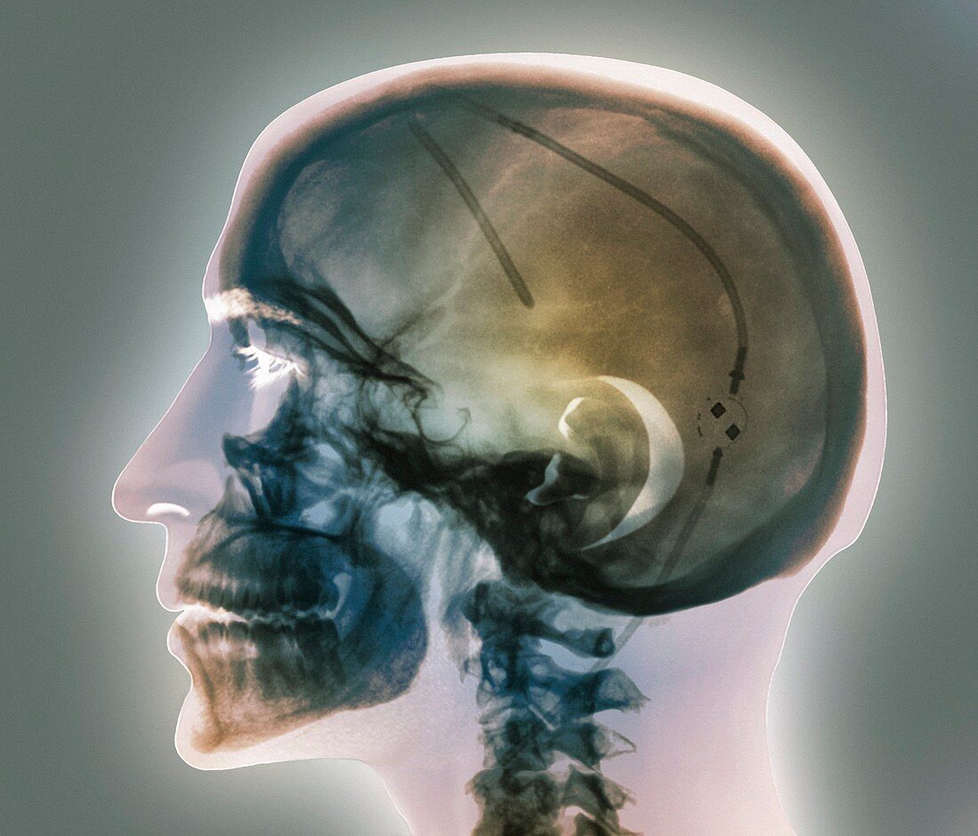 Ventricular shunt,X-ray