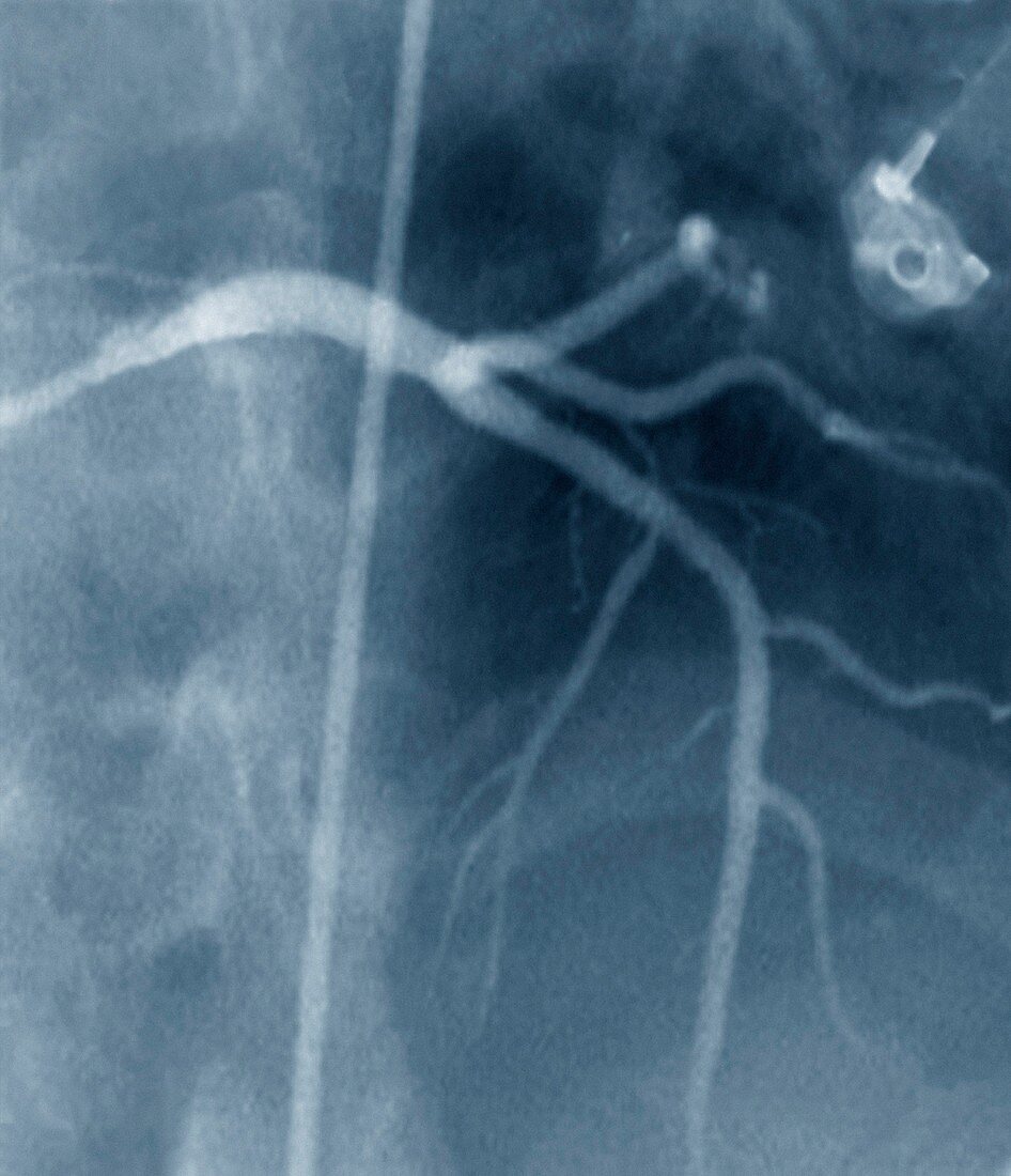 Coronary stenosis after treatment,X-ray