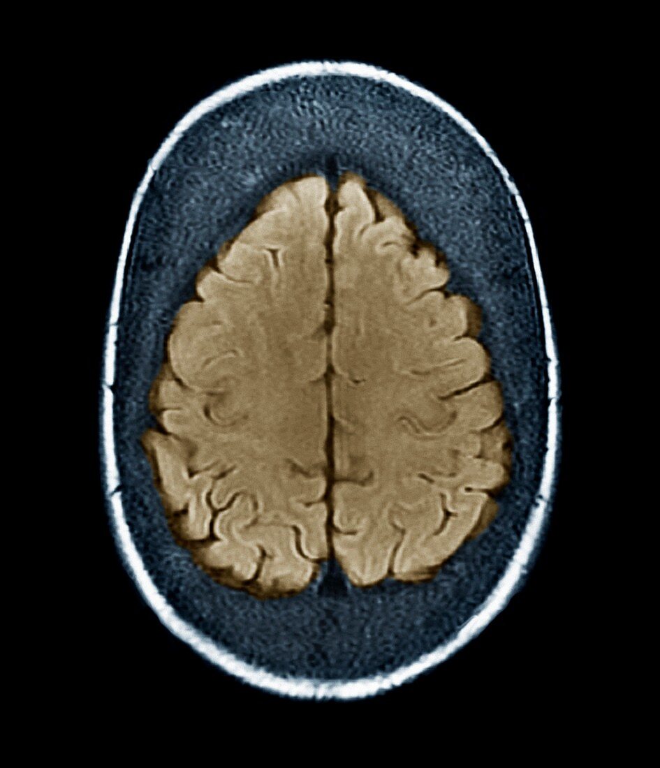 Thickened skull,MRI scan
