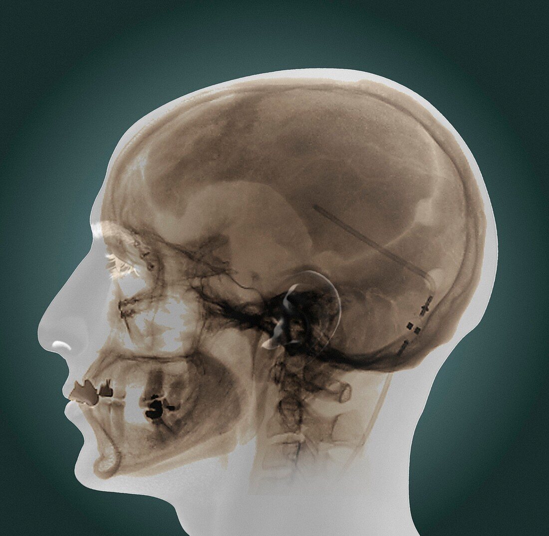 Ventricular shunt,X-ray