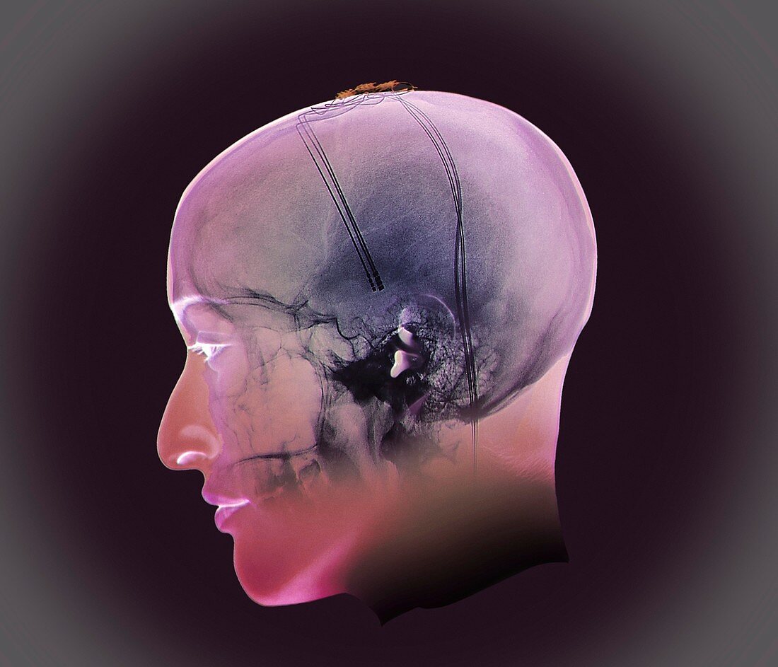 Deep brain stimulation,X-ray