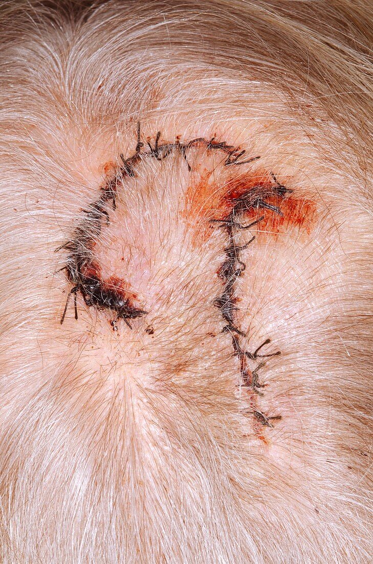 Sutures in the scalp after a fall