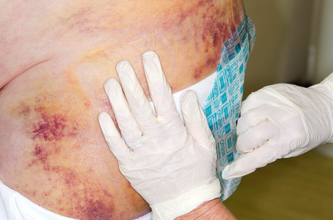 Dressing a wound after hip surgery