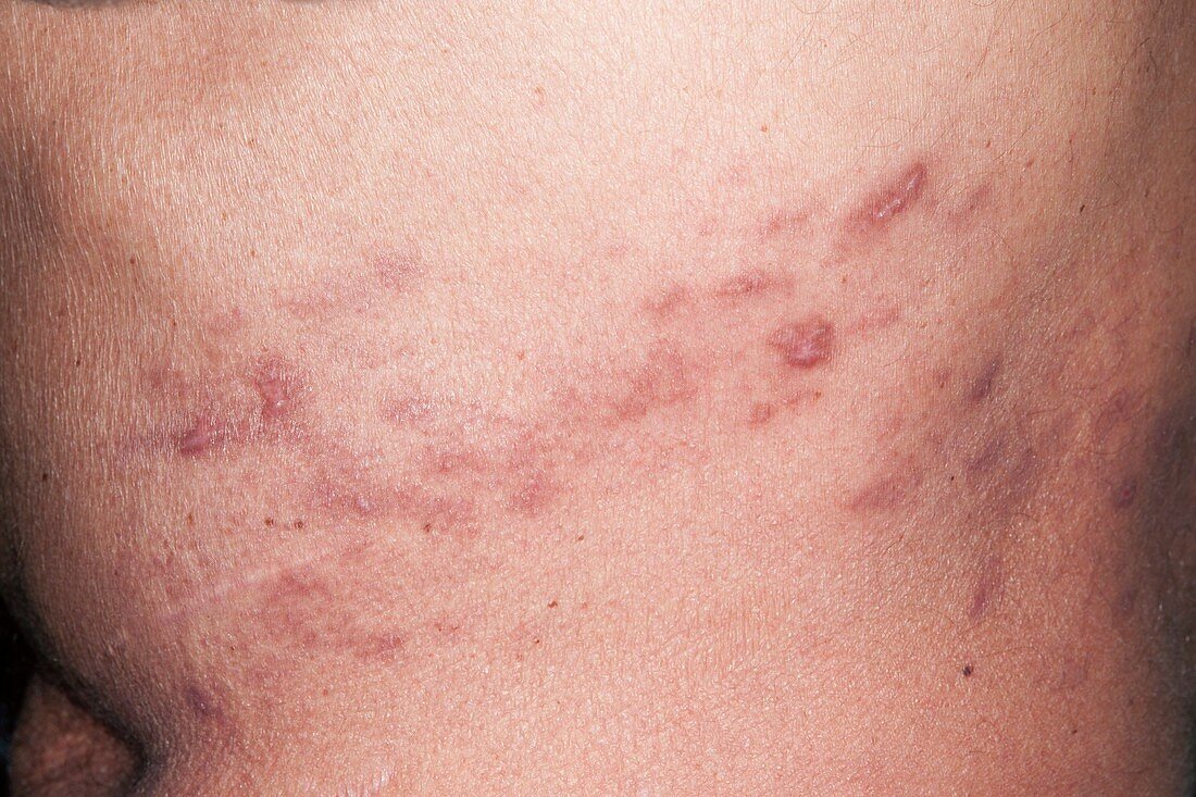 Resolving shingles rash