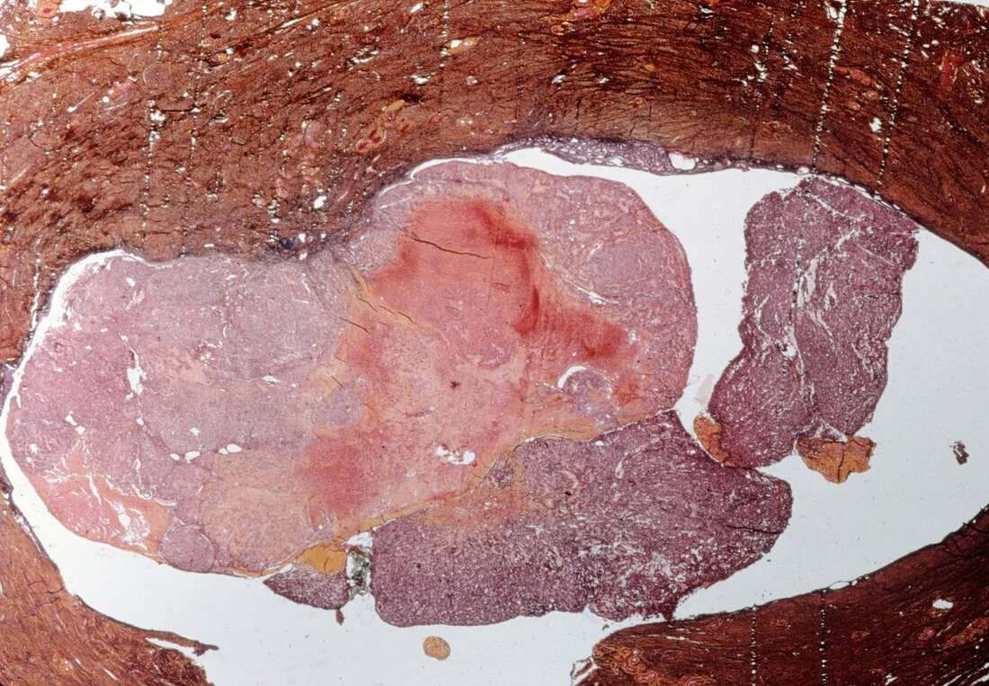 Endometrial cancer,light micrograph